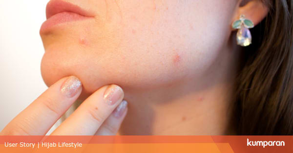 Orang Yang Berjerawat Cenderung Menua Lebih Lambat - kumparan.com